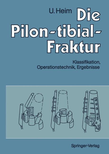 Die Pilon-tibial-Fraktur