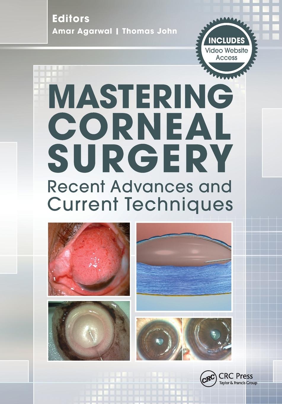 Mastering Corneal Surgery