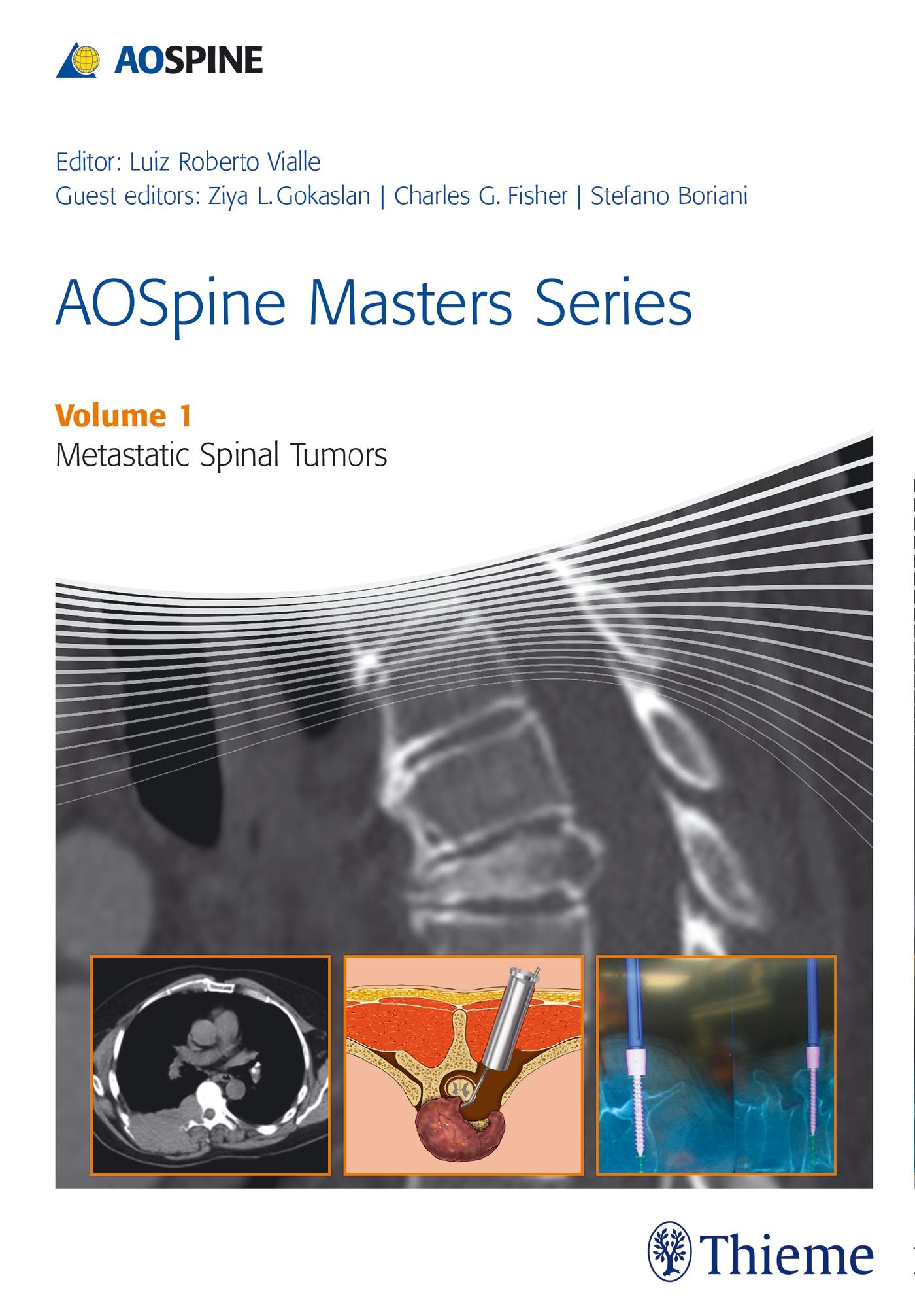 Aospine Masters Series Volume 1: Metastatic Spinal Tumors