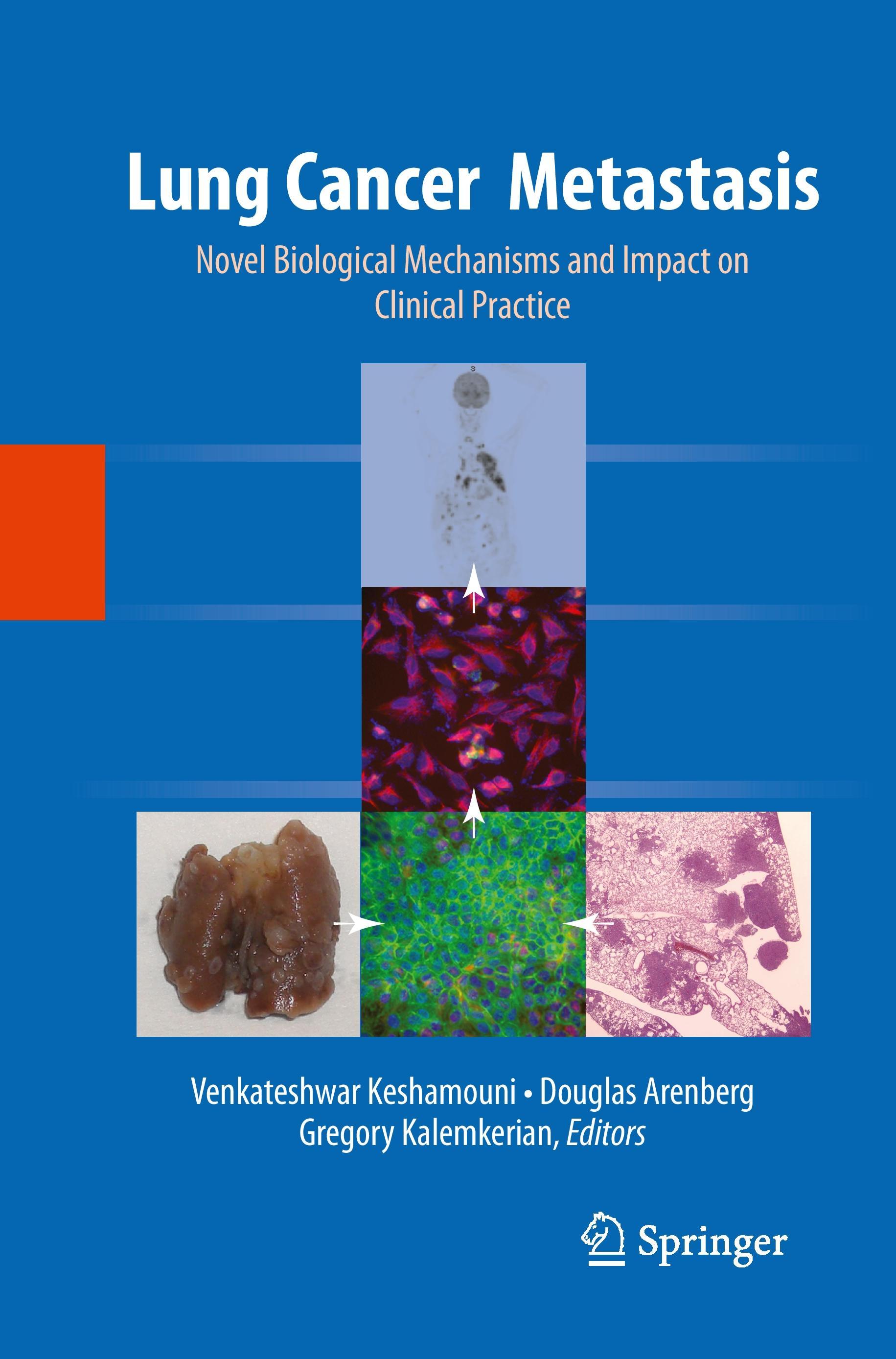 Lung Cancer Metastasis