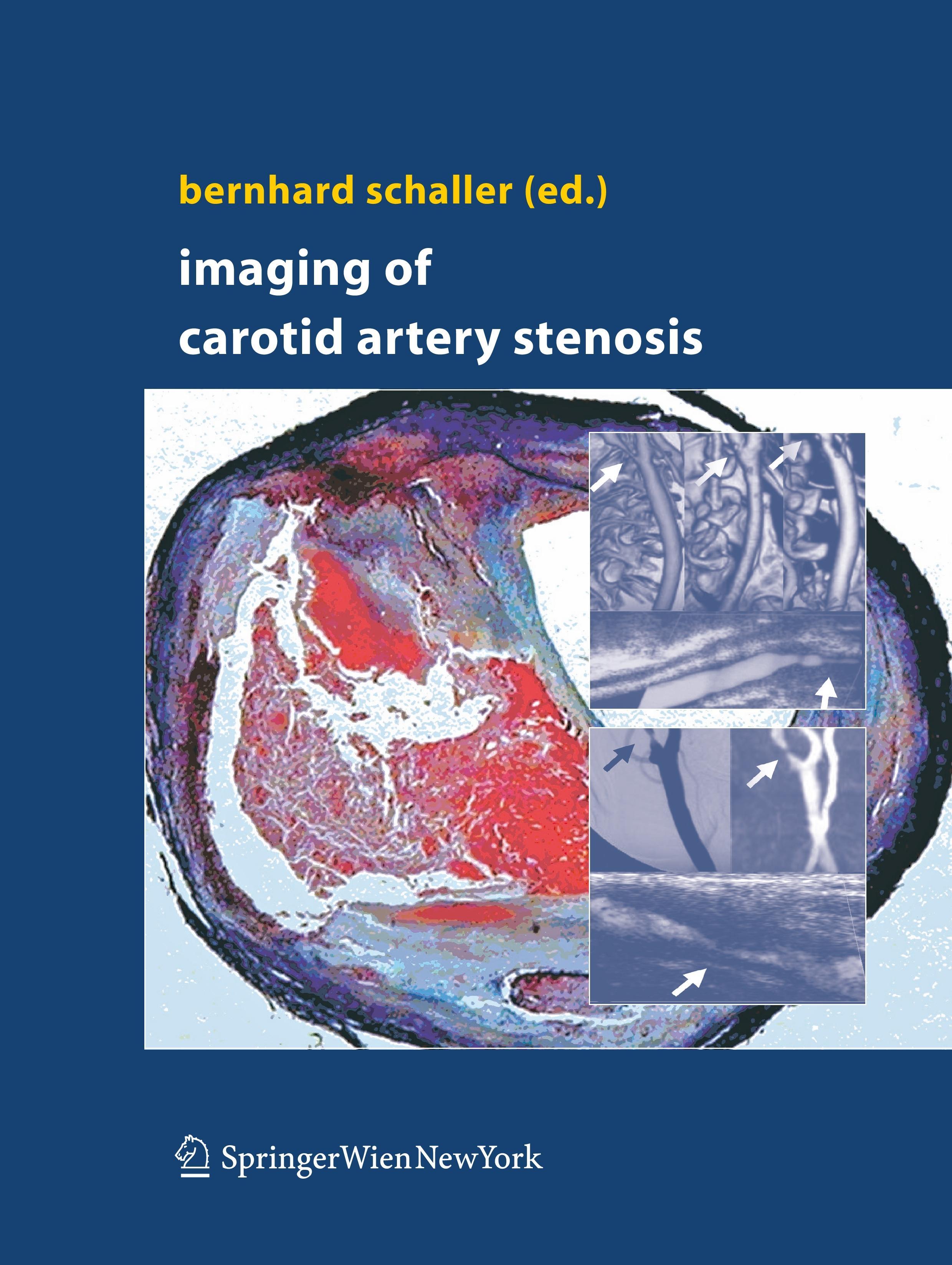 Imaging of Carotid Artery Stenosis