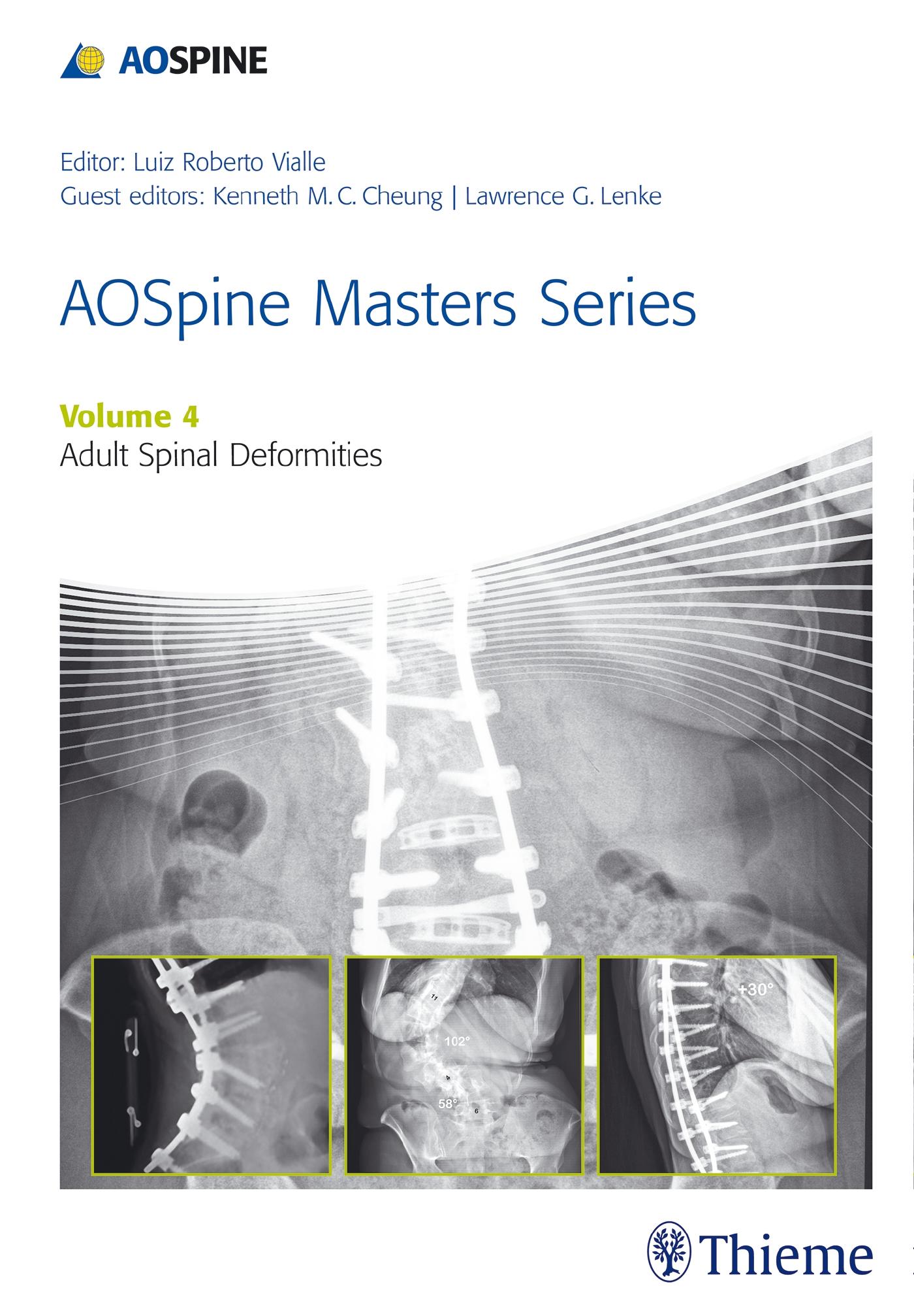 Aospine Master Series, Vol. 4: Adult Spinal Deformities