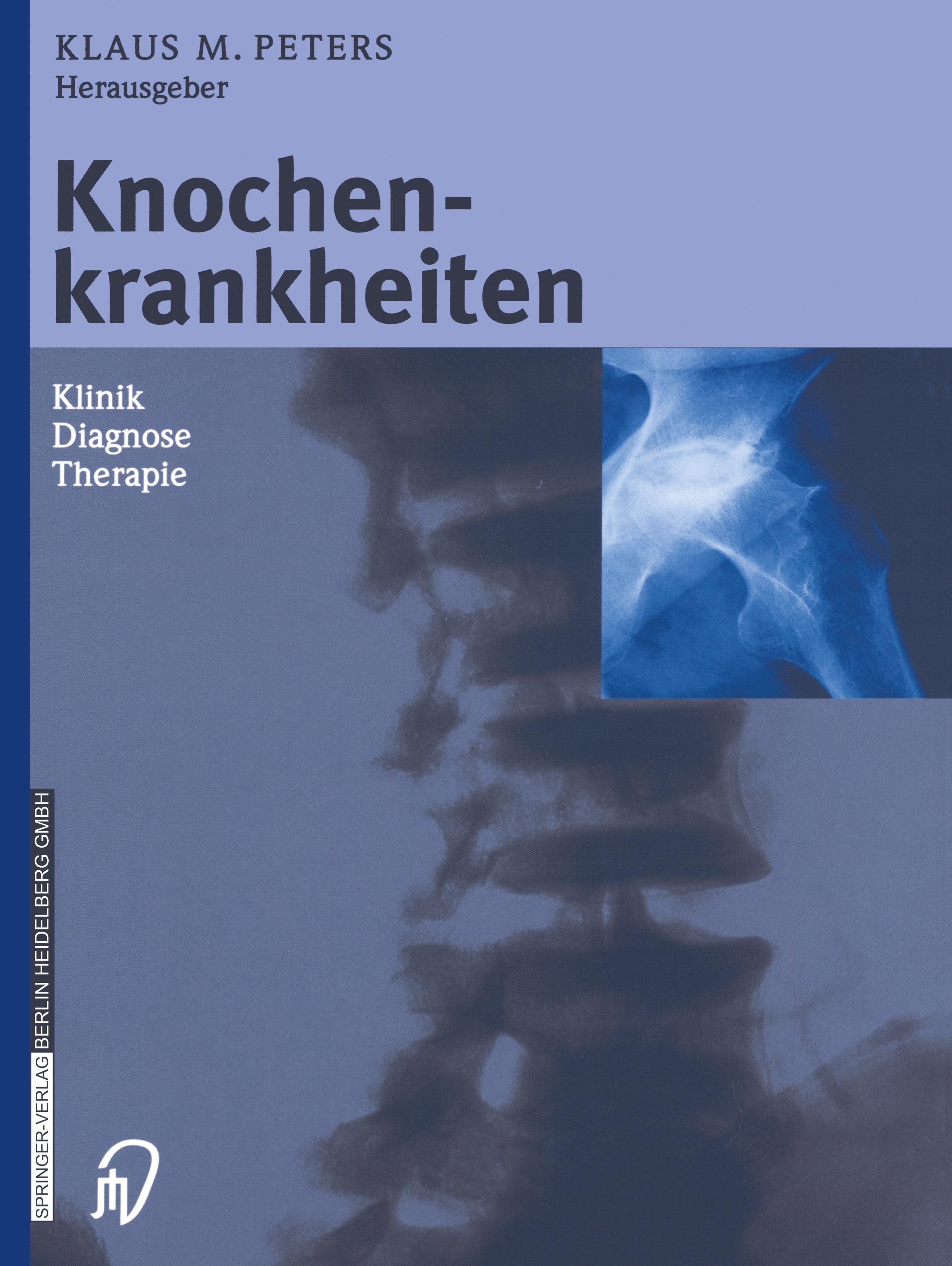 Knochenkrankheiten