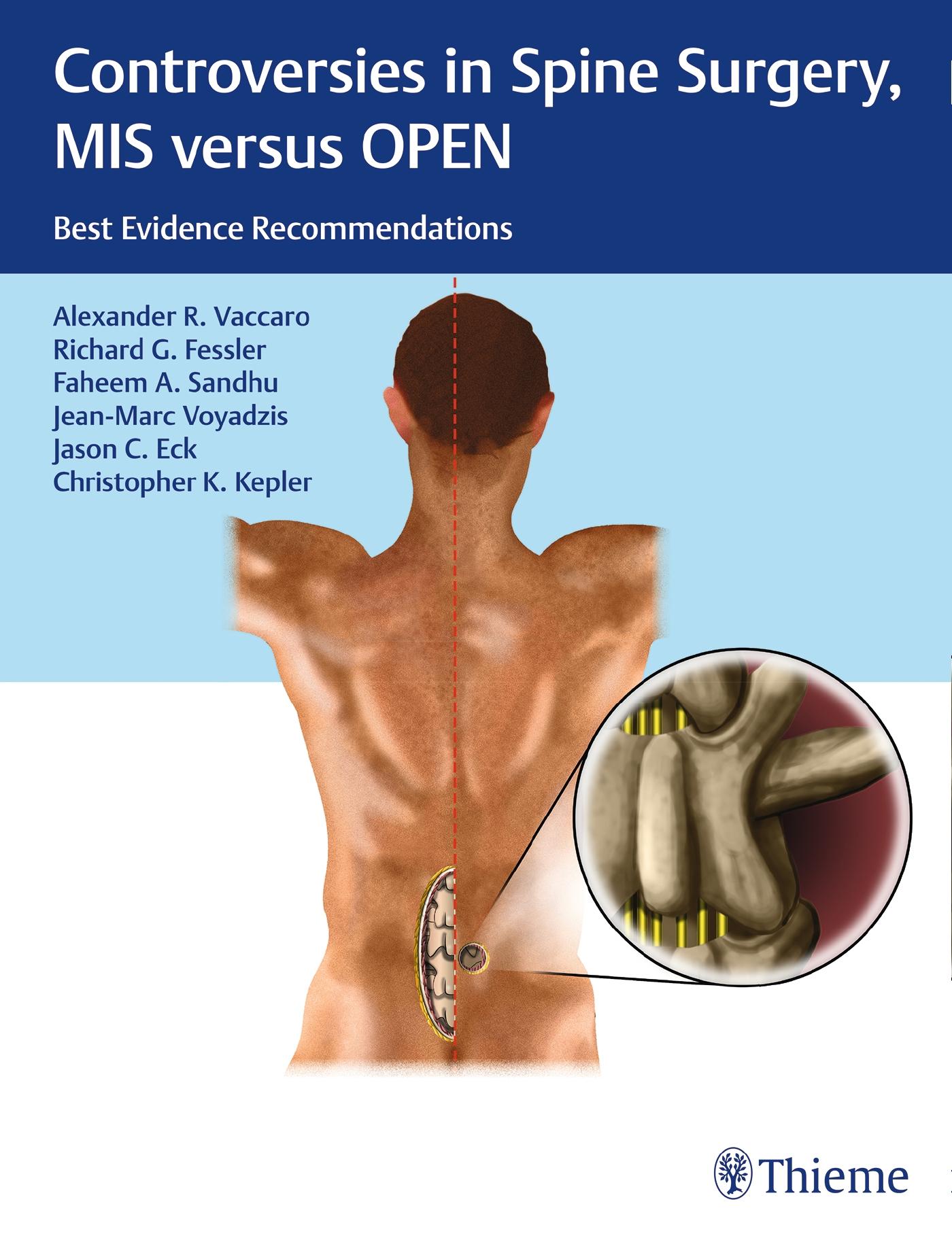 Controversies in Spine Surgery, MIS Versus Open