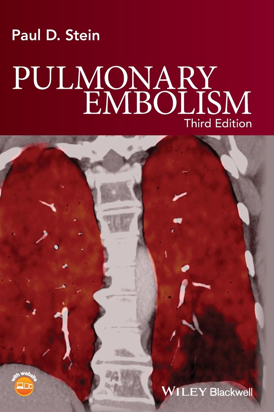 Pulmonary Embolism