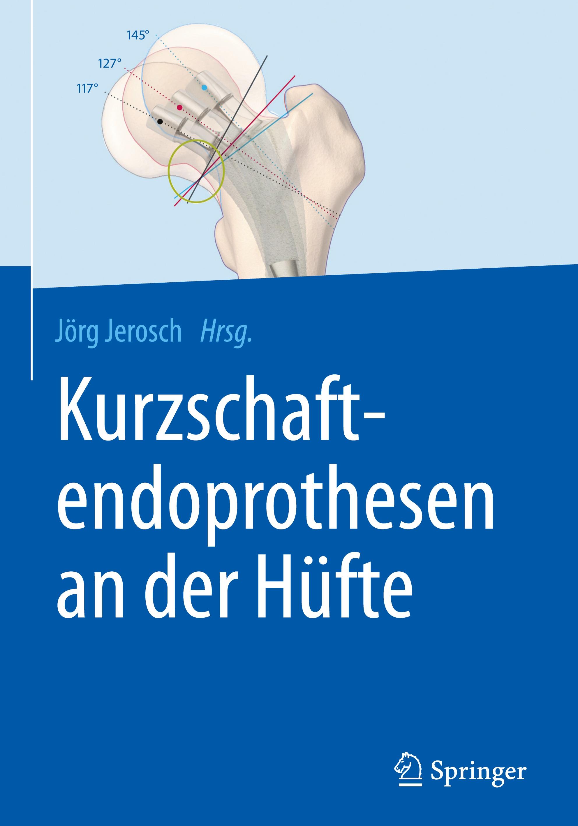 Kurzschaftendoprothesen an der Hüfte