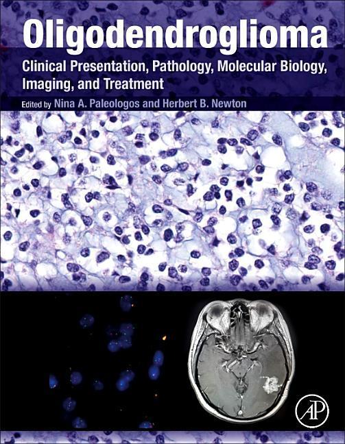 Oligodendroglioma