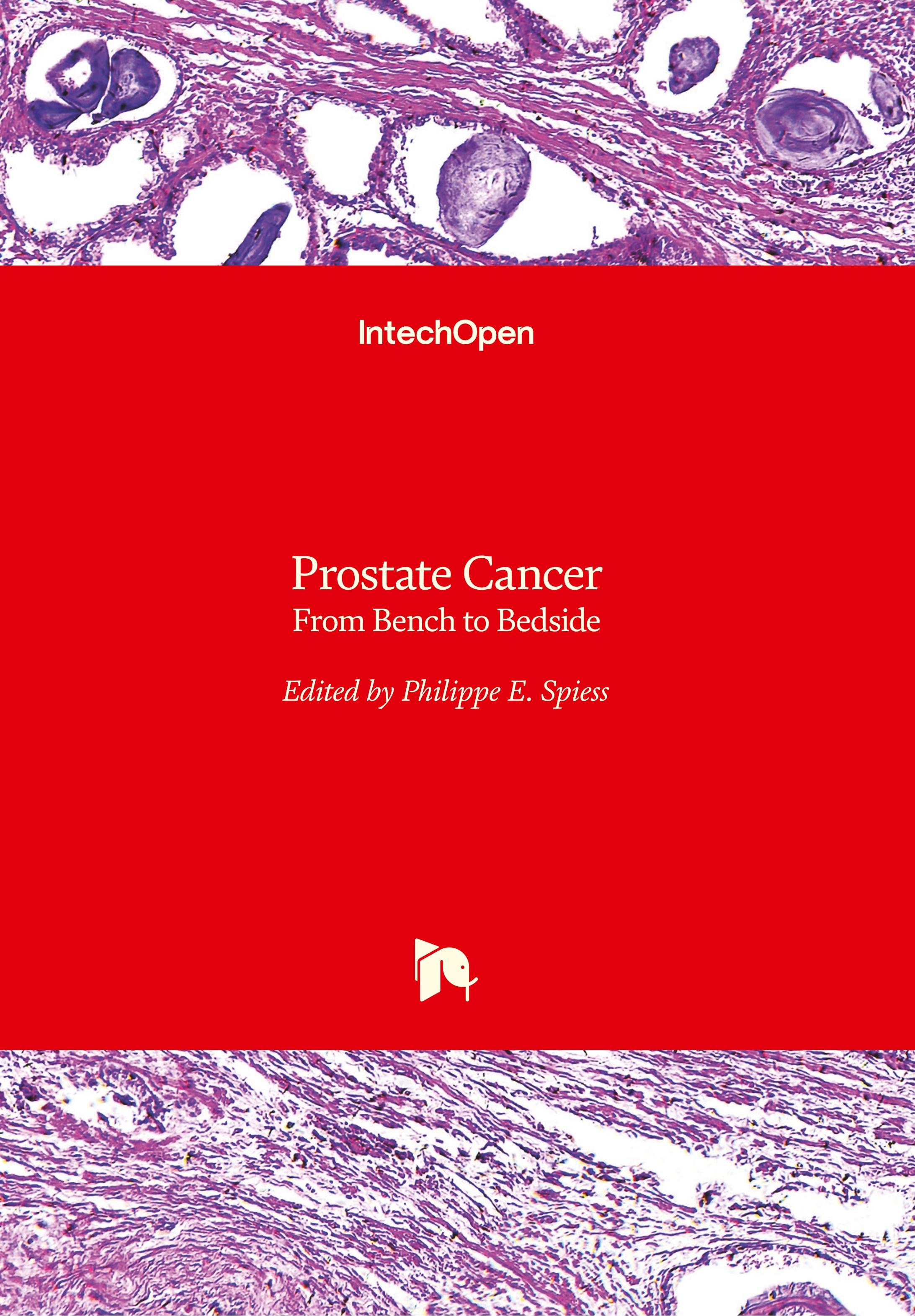 Prostate Cancer