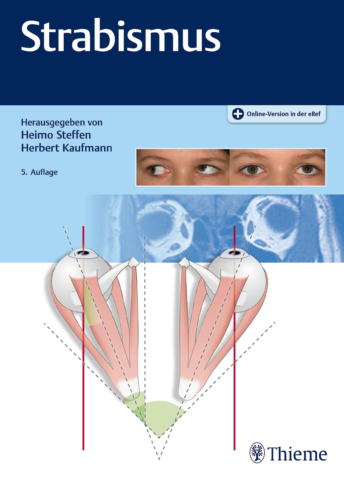 Strabismus