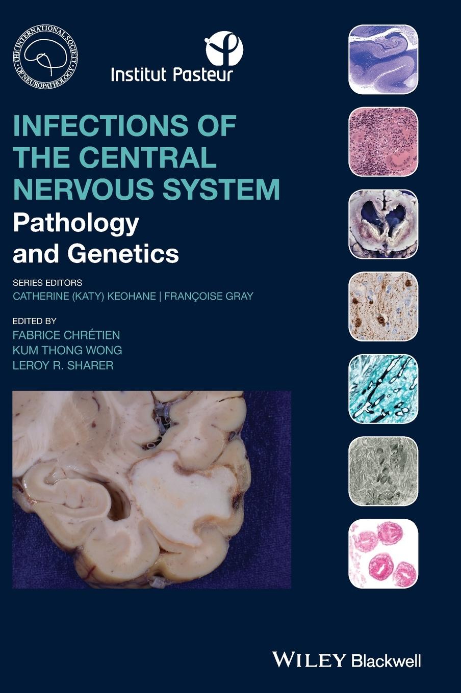 Infections of the Central Nervous System