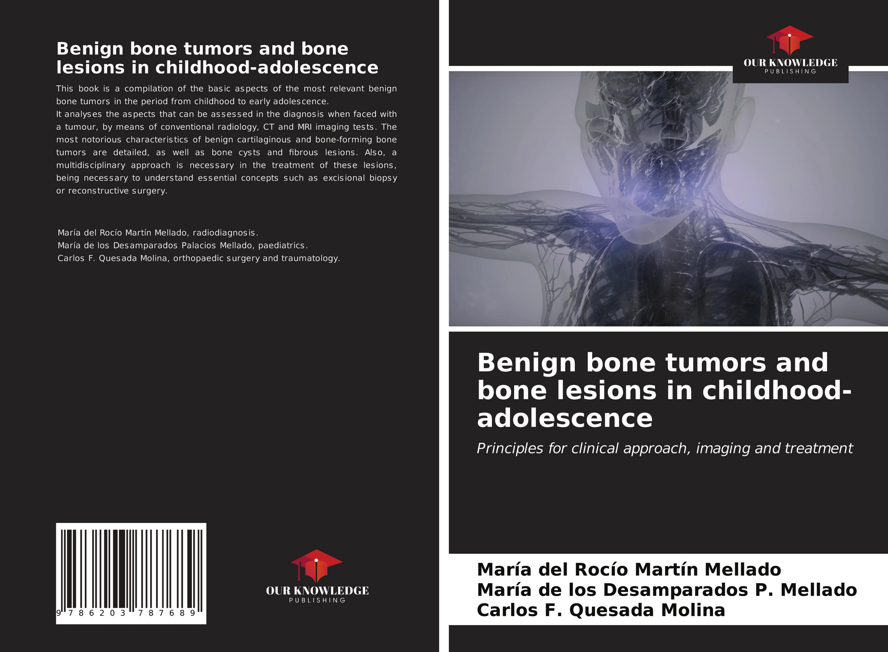 Benign bone tumors and bone lesions in childhood-adolescence