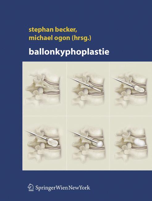 Ballonkyphoplastie