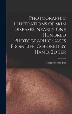 Photographic Illustrations of Skin Diseases, Nearly One Hundred Photographic Cases From Life, Colored by Hand. 2d Ser