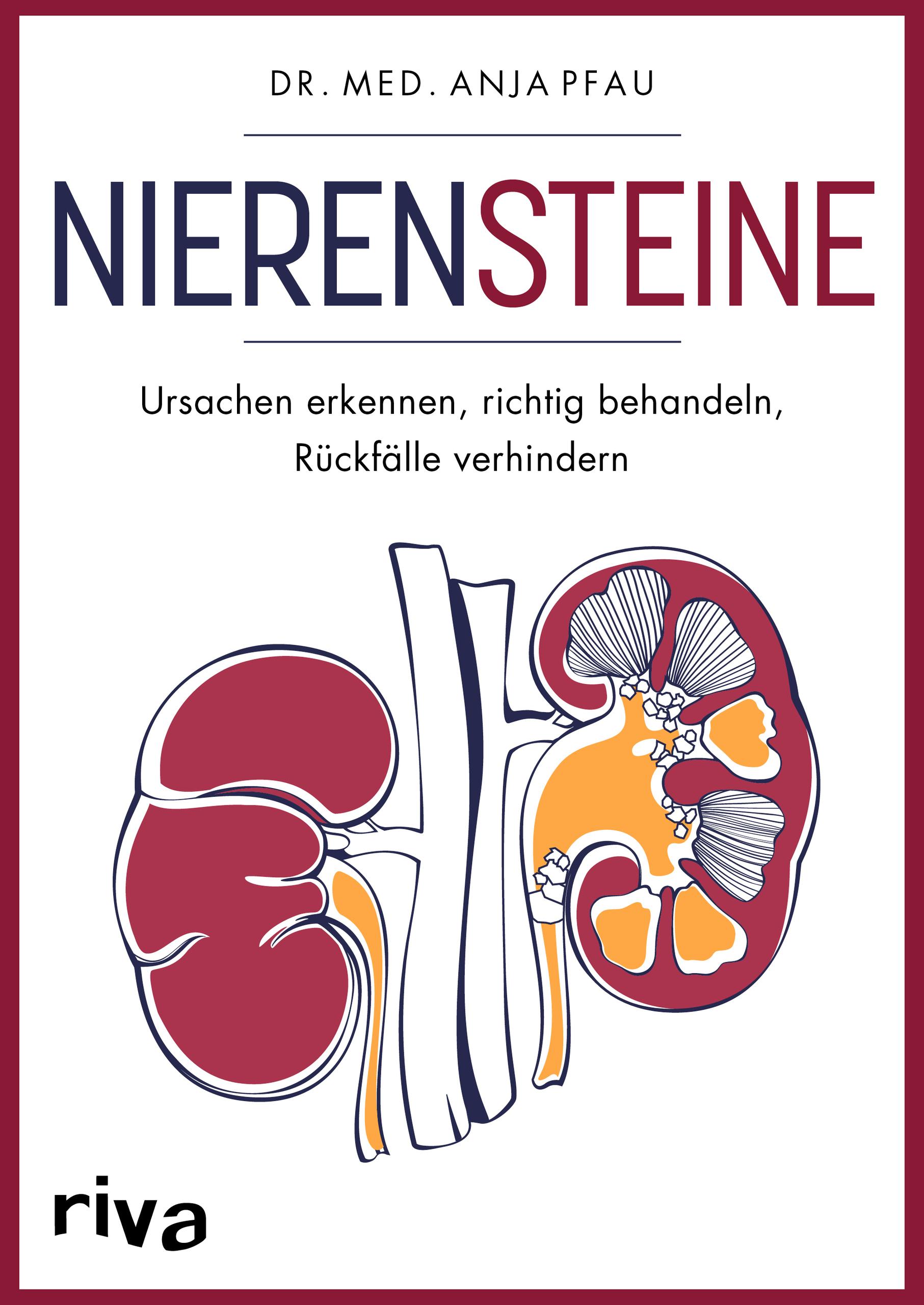 Nierensteine - Ursachen erkennen, richtig behandeln, Rückfälle verhindern