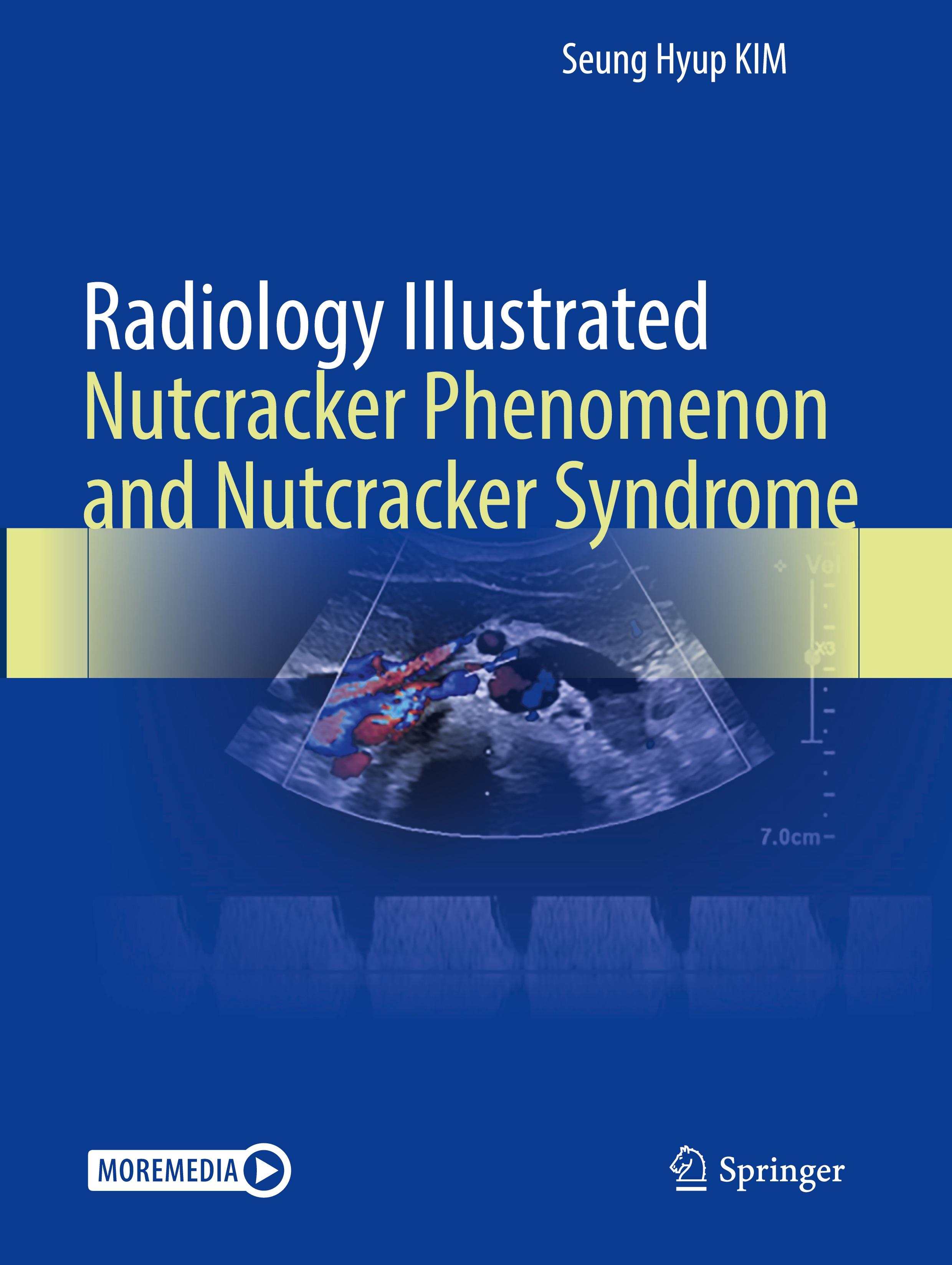 Radiology Illustrated: Nutcracker Phenomenon and Nutcracker Syndrome