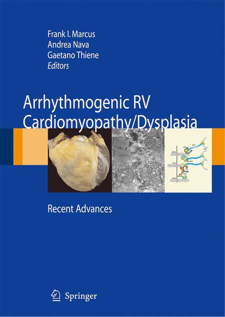 Arrhythmogenic RV Cardiomyopathy/Dysplasia