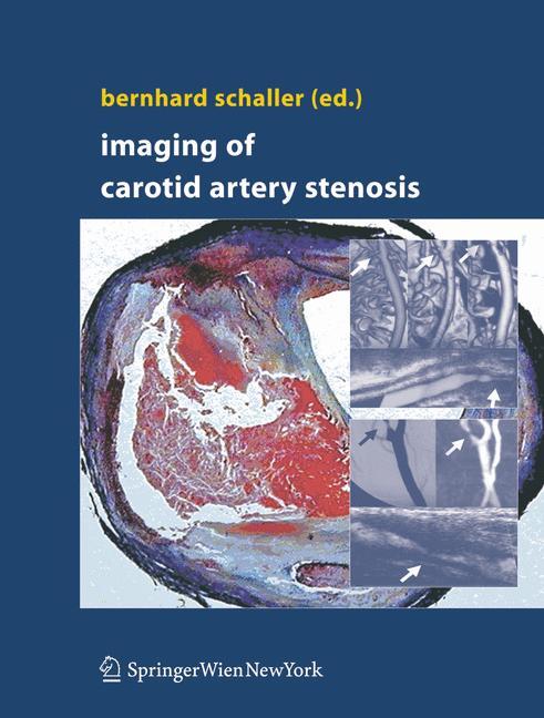 Imaging of Carotid Artery Stenosis