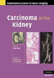 Carcinoma of the Kidney