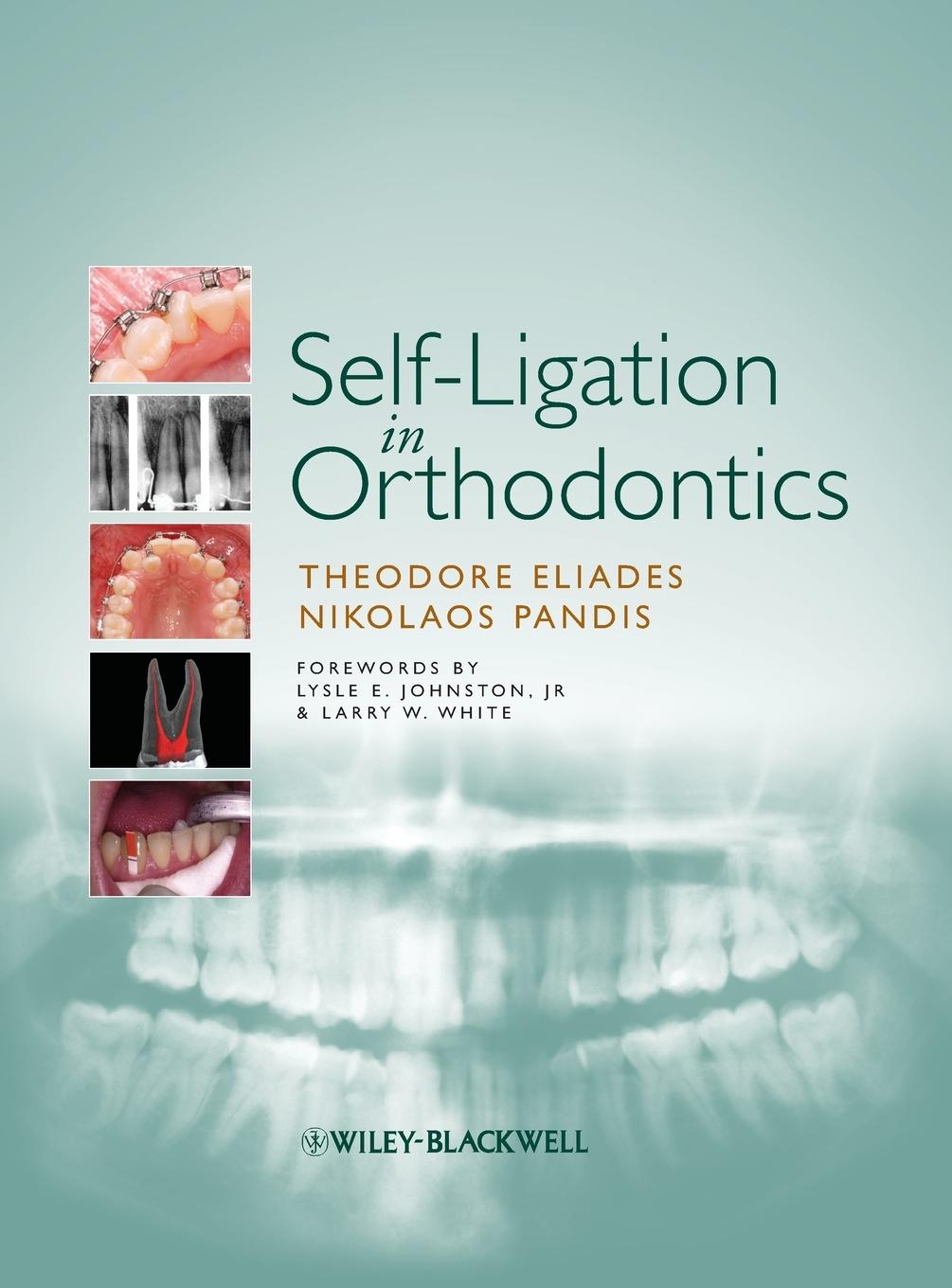 Self-Ligation in Orthodontics