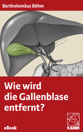 Wie wird die Gallenblase entfernt?