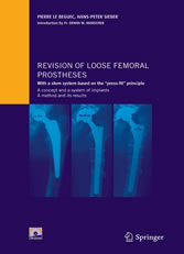 Revision of loose femoral prostheses with a stem system based on the 'press-fit' principle