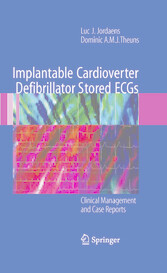 Implantable Cardioverter Defibrillator Stored ECGs