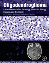 Oligodendroglioma