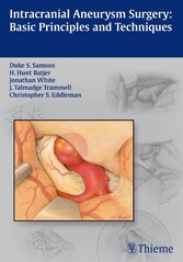 Intracranial Aneurysm Surgery