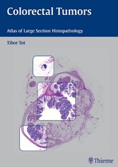 Colorectal Tumors