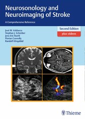 Neurosonology and Neuroimaging of Stroke