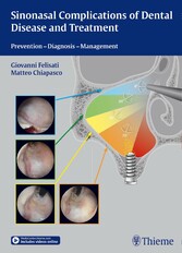 Sinonasal Complications of Dental Disease and Treatment