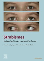 Strabisme