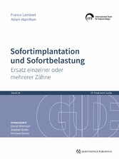 Sofortimplantation und Sofortbelastung