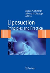 Liposuction