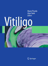 Vitiligo